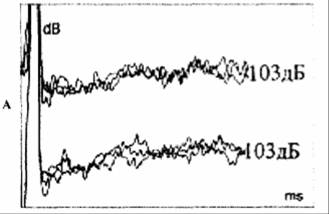 КСВП при предъявлении звуковых щелчков уровнем 103 дБ в левое (верхняя кривая) и правое (нижняя кривая) ухо. КСВП - не зарегистрированы