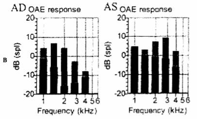 ЗВОАЭ при предъявлении щелчка в правое (AD) и левое (AS) ухо. ЗВОАЭ зарегистрирована во всех частотных диапазонах. Черные столбцы - уровень шума, серые столбцы - ЗВОАЭ.