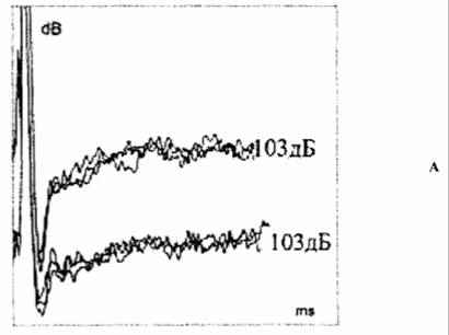 КСВП при предъявлении звуковых щелчков уровнем 103 дБ в левое (верхняя кривая) и правое (нижняя кривая) ухо. КСВП - не зарегистрированы.