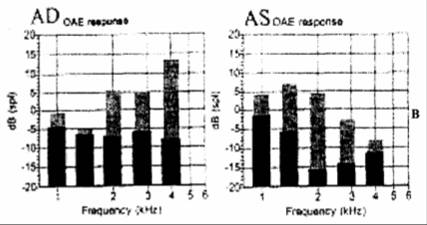 ЗВОАЭ при предъявлении щелчков в правое (АD) и левое (АS) ухо. ЗВОАЭ зарегистрирована во всех частотных диапазонах. Черные столбцы - уровень шума, серые столбцы - ЗВОАЭ