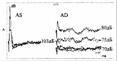 КСВП при предъявлении звуковых щелчков уровнем 103 дБ в левое ухо (АS) не зарегистрирован, порог обнаружения КСВП при предъявлении щелчков в правое ухо (АD) - 75 дБ.