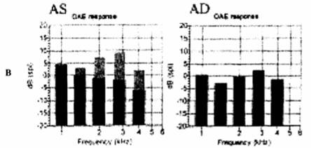 ЗВОАЭ при предъявлении щелчков в правое (АD) и левое (АS) ухо, ЗВОАЭ зарегистрирована во всех частотных диапазонах. Черные столбцы - уровень шума, серые столбцы - ЗВОАЭ.