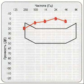 Пороги слышимости в свободном звуковом поле, полученные при использовании ВАНА, которых можно ожидать для пациентов с кондуктивной потерей слуха.