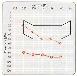 Аудиограмма, представляющая идеальный гипотетический случай общей кондуктивной потери слуха