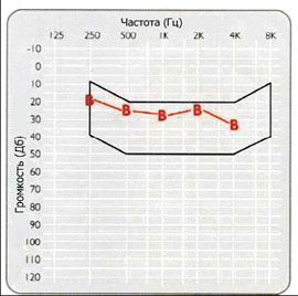 Пример порогов слышимости в свободном звуковом поле, полученных с помощью ВАНА для пациента со смешанной потерей слуха.