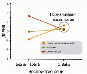 Улучшенные пороги слышимости для пациентов, носящих ВАНА в одном ухе с глубокой потерей слуха, и имеющих слабую потерю слуха в противоположном ухе.